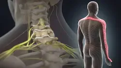 Uzroci cervikalne radikulopatije, manuelna terapija pravdic